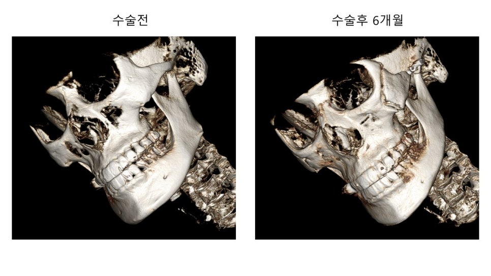 안면윤곽 수술전과 후의 증례 고찰 관련 이미지 11