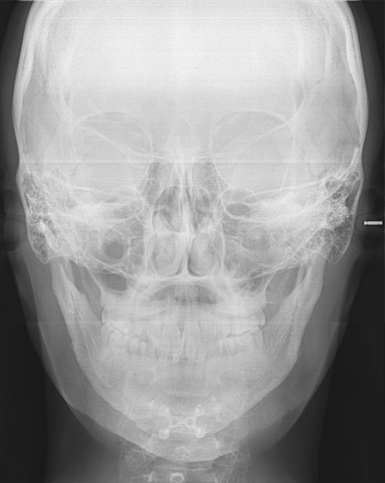 V-Line Square Jaw Revision Surgery image 6