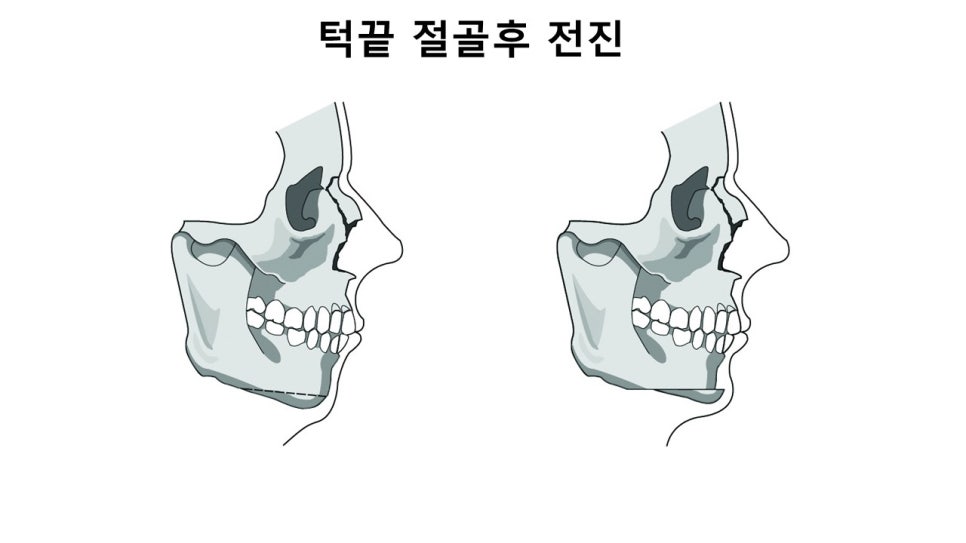 입체적인 옆라인의 완성, 무턱과 이중턱을 동시에 해결하는 방법 관련 이미지 20