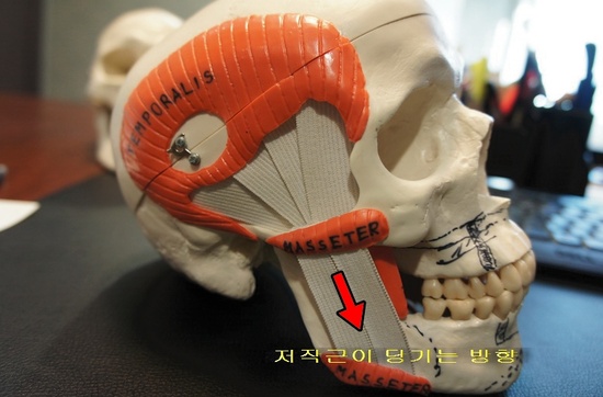 광대뼈 수술방법에 따른 문제점들.. 관련 이미지 4