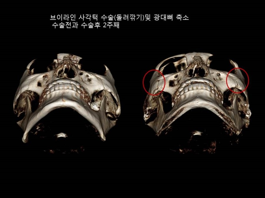 얼굴형에 따른 적절한 광대뼈 축소성형술의 다양한 응용 관련 이미지 7