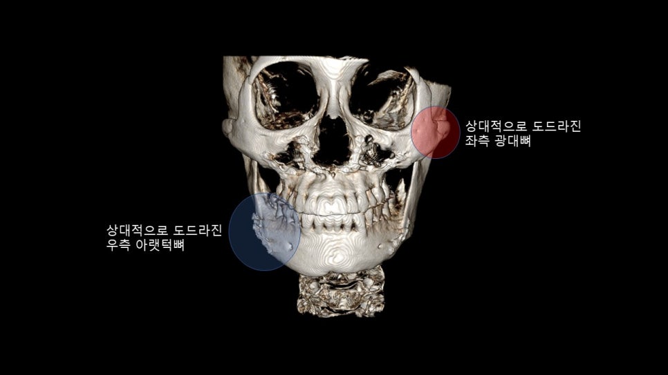 광대뼈축소성형술 증례 리뷰 -1 관련 이미지 1
