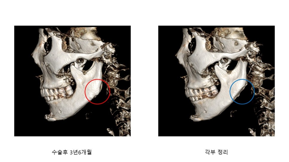 사각턱 수술후 시기에 따른 아랫턱뼈의 형태변화 관련 이미지 16