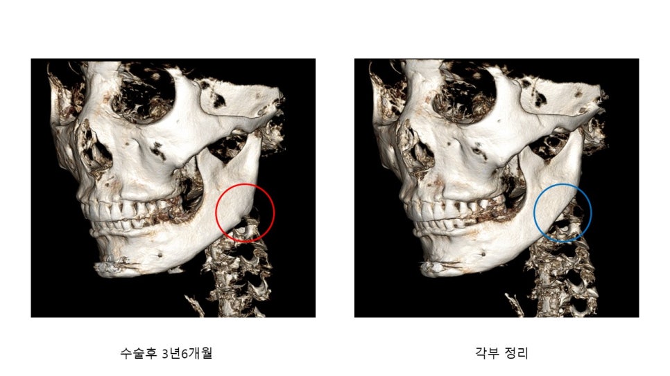 사각턱 수술후 시기에 따른 아랫턱뼈의 형태변화 관련 이미지 10