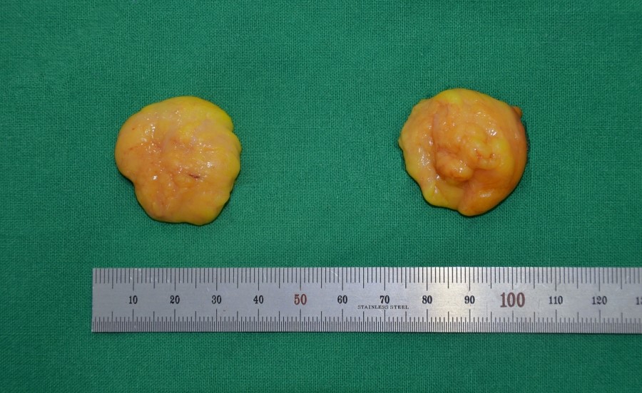 The Amount of Deep Buccal Fat Removed During Deep Buccal Fat Removal image 4
