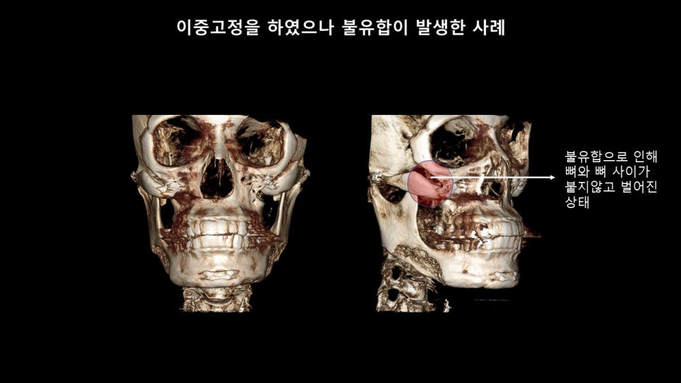 광대뼈축소성형술 증례 리뷰 -1 관련 이미지 8