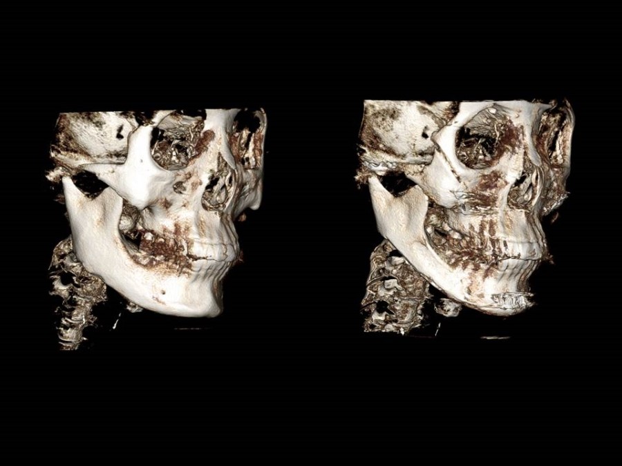 Zygoma Reduction Surgery Through Complete Osteotomy of the Body and Arch image 27