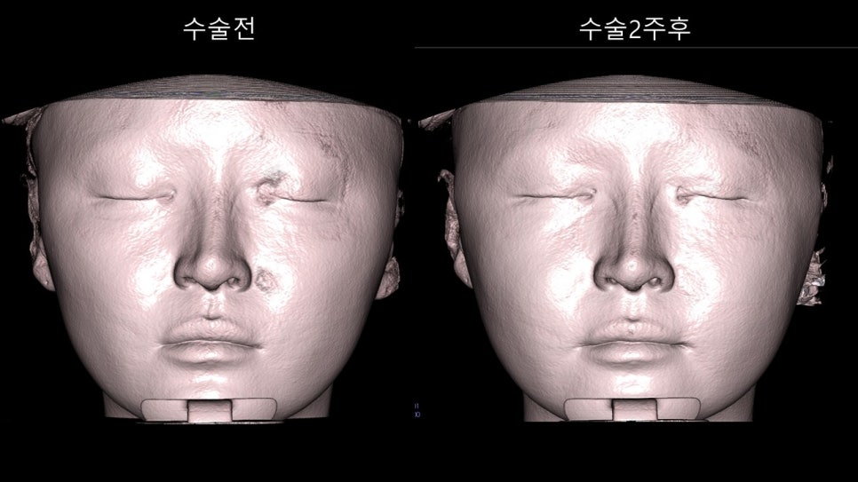 안면윤곽수술후 모습이 바뀌어 보이려면 얼마나 기다려야 할까? "윤곽수술과 술후 다운타임및 술후 관리방법" 관련 이미지 33