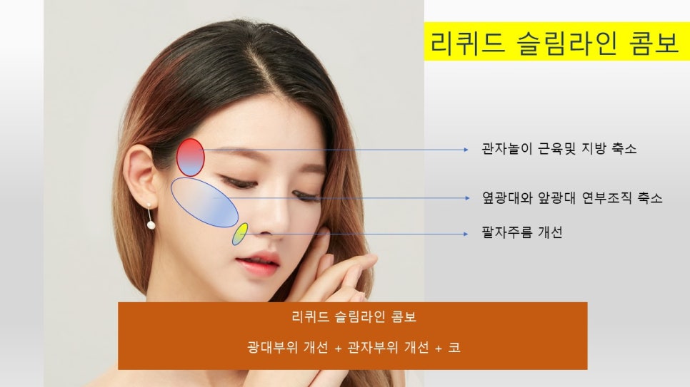 Step-by-Step Suggestions on Facial Contouring Surgery - 1. Liquid Facial Contouring image 9