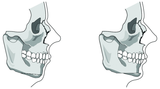 Profile Shaping - 1. Chin Surgery for a Recessed Chin image 1
