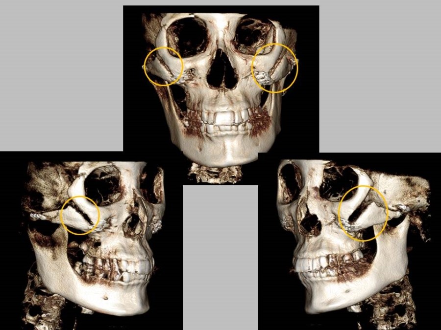 Meticulous Zygomatic Reduction Surgery image 4