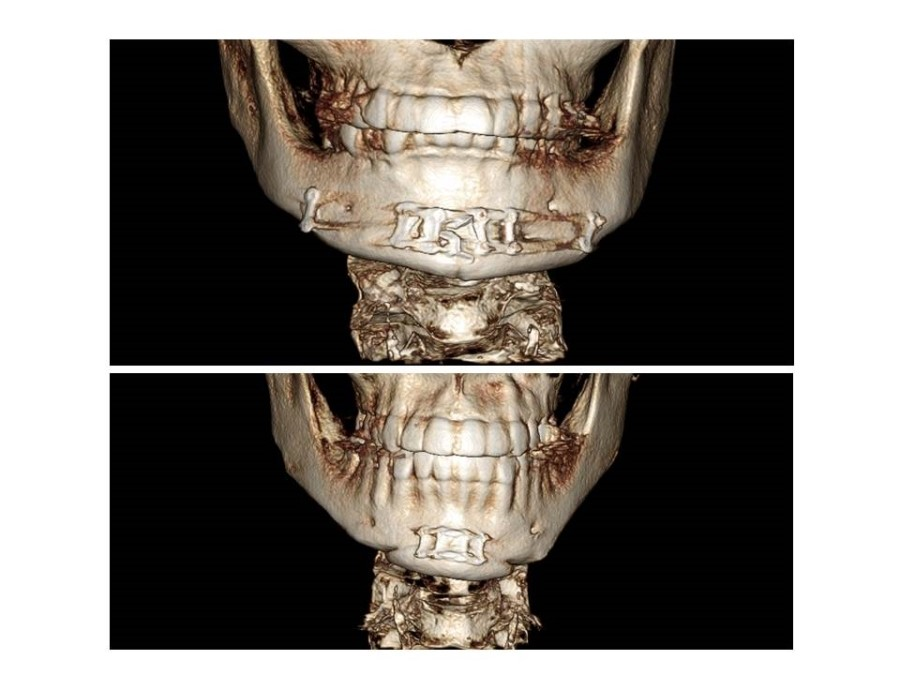 V-Line Square Jaw Surgery - The Appropriate Surgical Method According to the Shape of the Chin image 11