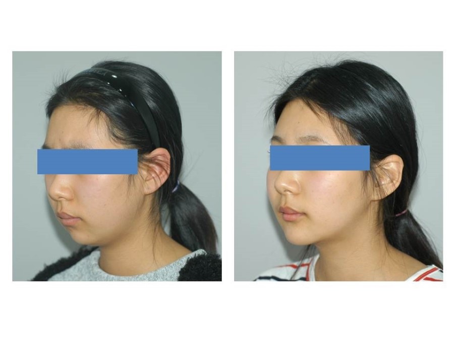 Deep Buccal Fat Removal, Double Chin Liposuction, and Progress After Genioplasty image 2