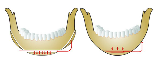 V-Line Facial Contouring Surgery - 2. When the Chin Length Is Short image 1