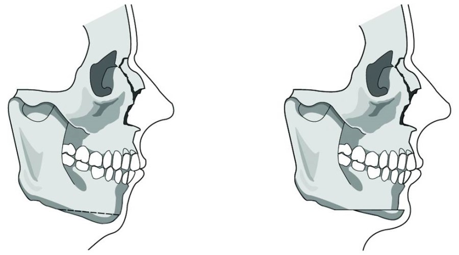 Overall Information About Chin Surgery for a Receded Chin image 3