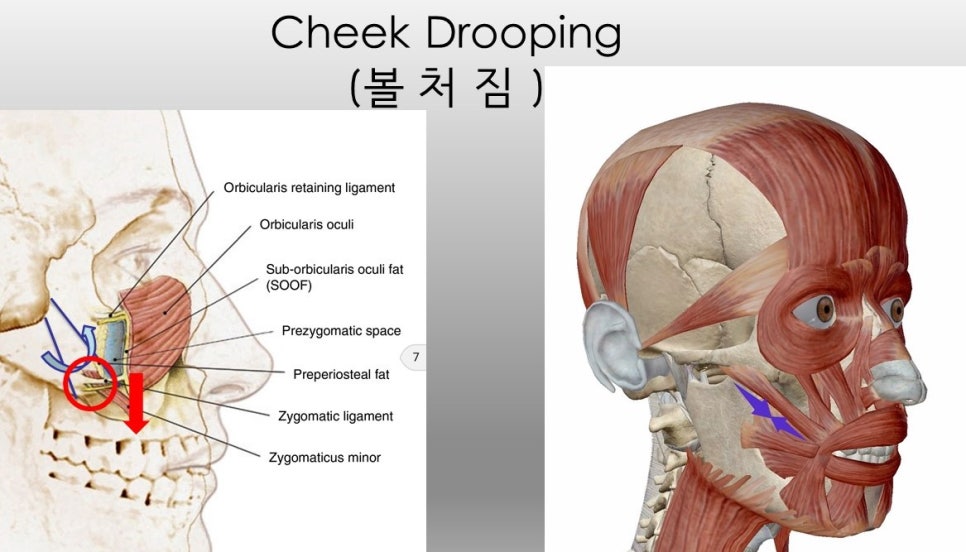광대뼈축소성형술 - 볼처짐의 원인에 관한 이해 관련 이미지 7