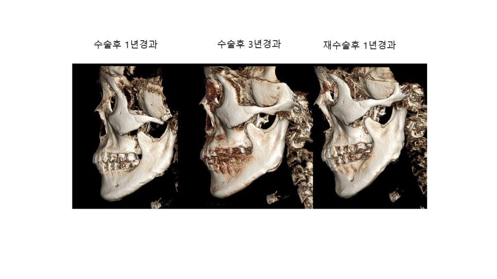 사각턱 수술후 시기에 따른 아랫턱뼈의 형태변화 관련 이미지 4
