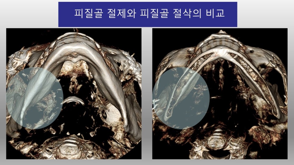 사각턱 수술과 피질골 절제에 관한 심층적 고찰 관련 이미지 5