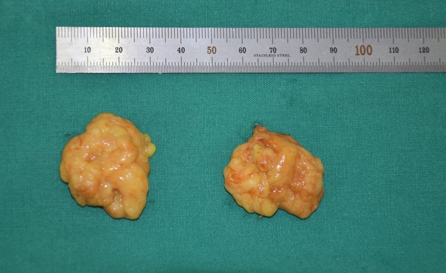 The Amount of Deep Buccal Fat Removed During Deep Buccal Fat Removal image 3