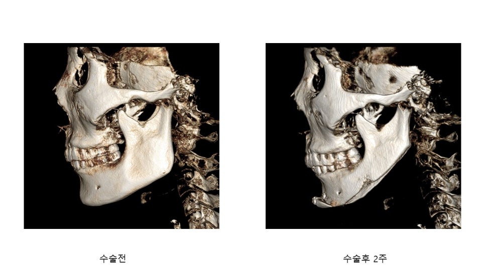 사각턱 수술후 시기에 따른 아랫턱뼈의 형태변화 관련 이미지 14