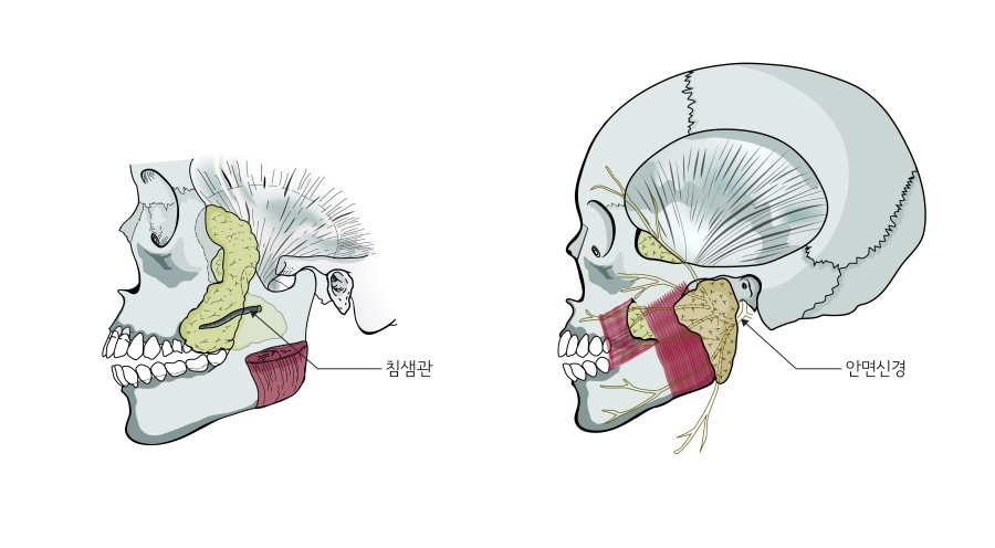 심부볼지방의 위치와 심부볼지방제거 수술시 개선되는 부위 관련 이미지 1