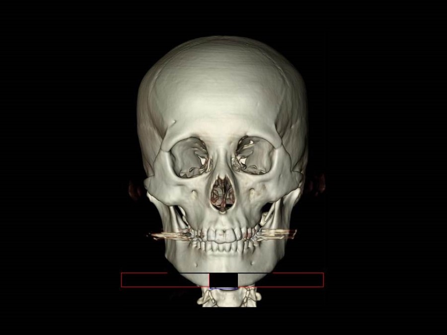 V-Line Square Jaw Surgery - The Truth and Reality of T-Osteotomy image 4