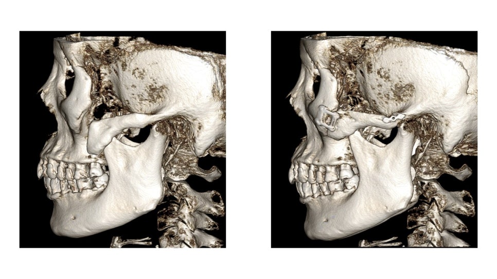 Why Cheekbone Revision Surgery for Sagging Cheeks and Nonunion 30 Years After Cheekbone Surgery Succeeded After a Facelift image 8