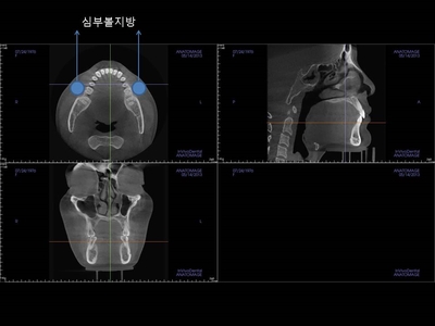 안면윤곽수술에 관한 연재 - 1. 심부볼지방제거 수술 관련 이미지 8