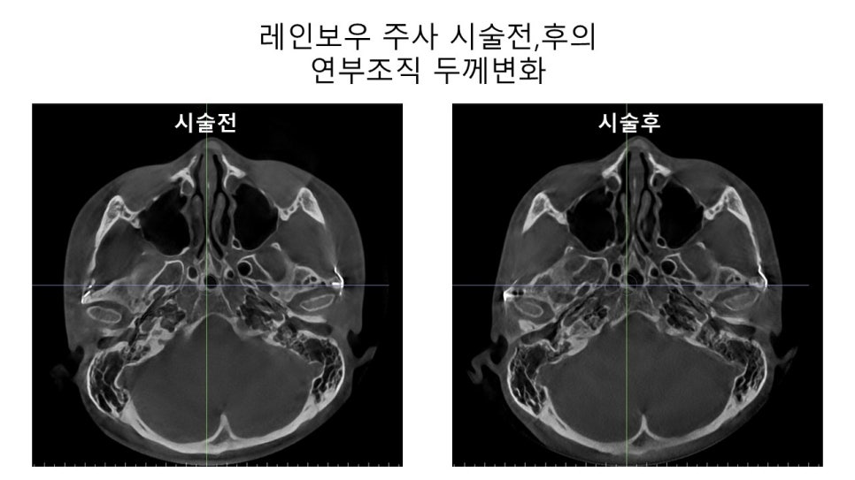 얼굴 윤곽에 있어서 연부조직의 중요성 - 윤곽주사, 레인보우 주사 관련 이미지 10