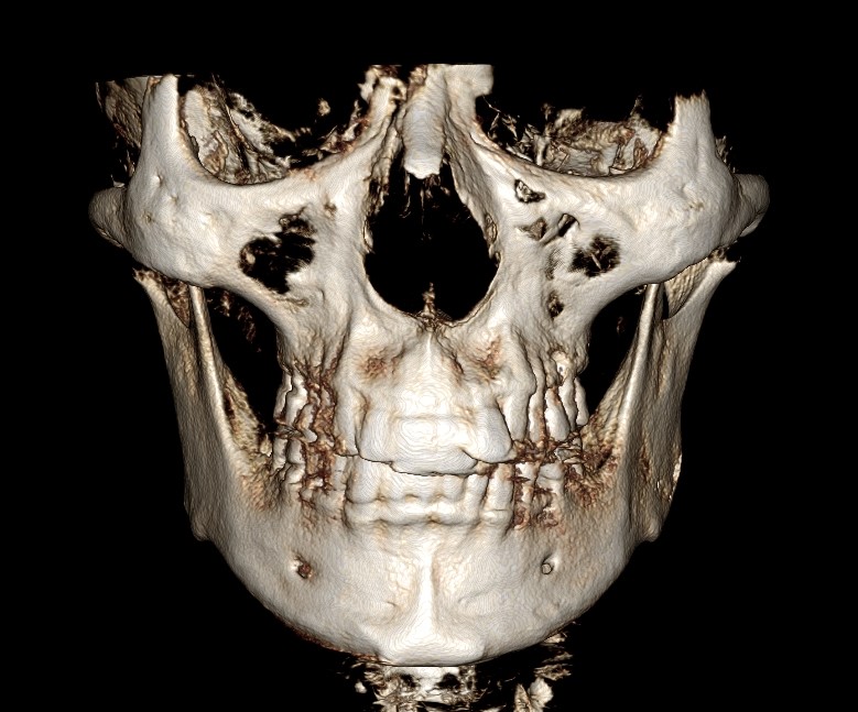 A General Understanding of Facial Contouring Surgery image 4