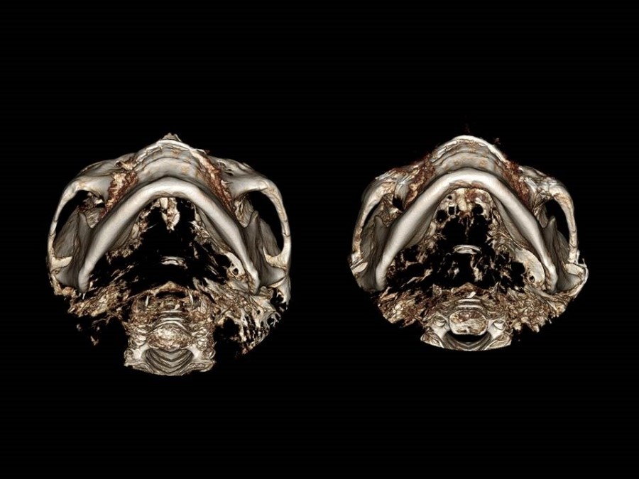 Zygoma Reduction Surgery Through Complete Osteotomy of the Body and Arch image 14