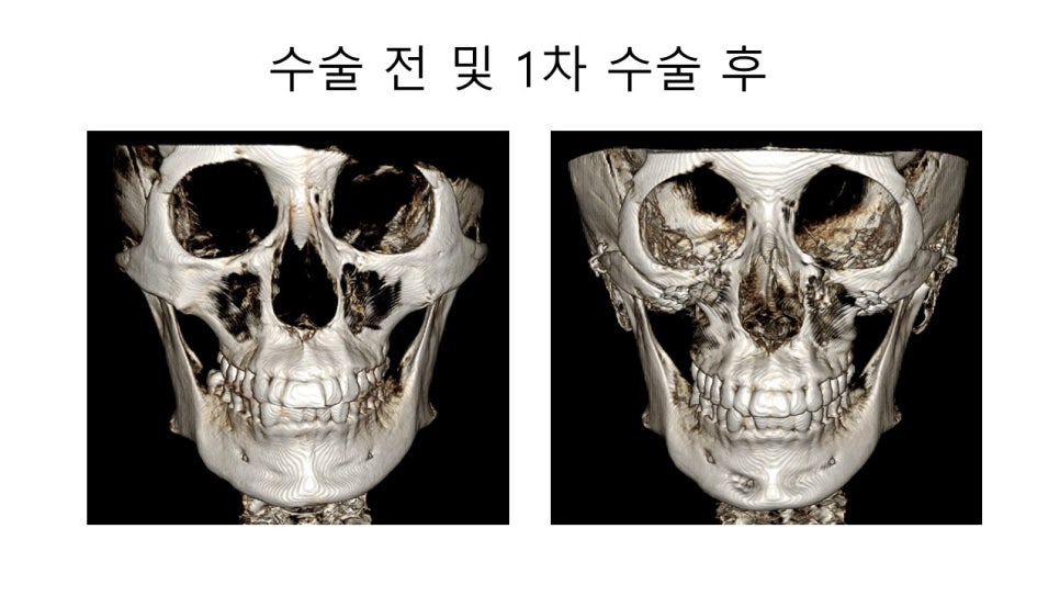 광대뼈 축소성형술 - 수술방법에 따른 모습변화의 차이 관련 이미지 3