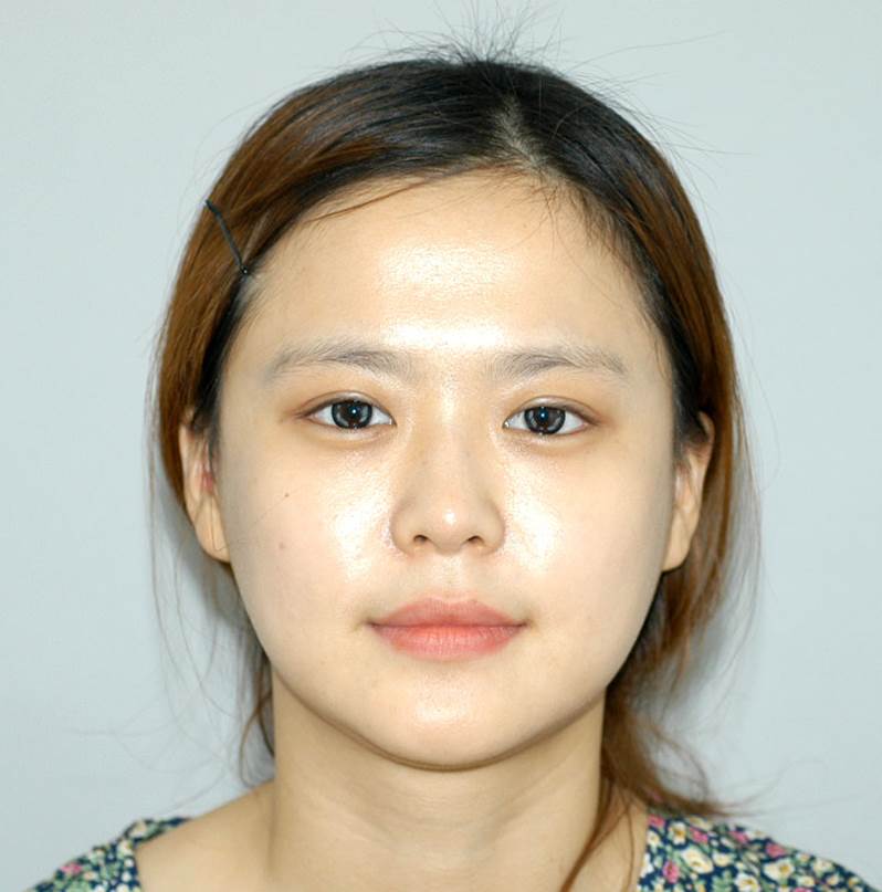 Progress After Facial Contouring Surgery 1 - Zygoma Reduction Surgery and Square Jaw Surgery image 4