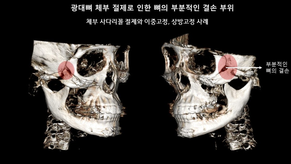 광대뼈축소성형술 증례 리뷰 -1 관련 이미지 6