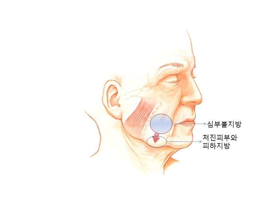 10 Q&As About Buccal Fat Removal Surgery image 2