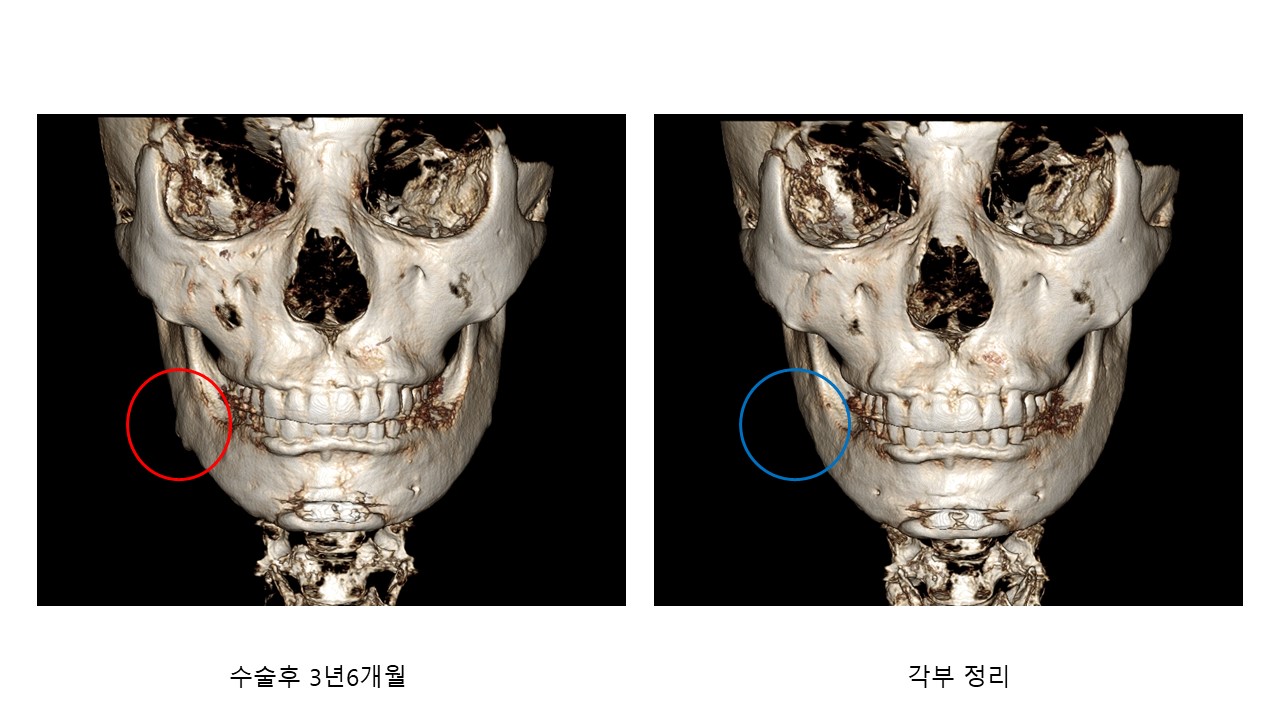 Bone Regeneration after Square Jaw Surgery 관련 이미지 7