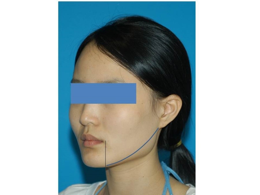 사각턱 수술과 V-라인 사각턱 수술 관련 이미지 2