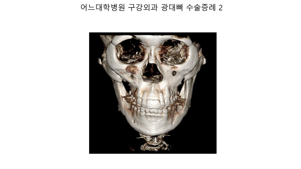 안면윤곽 수술전과 후의 증례 고찰 관련 이미지 16