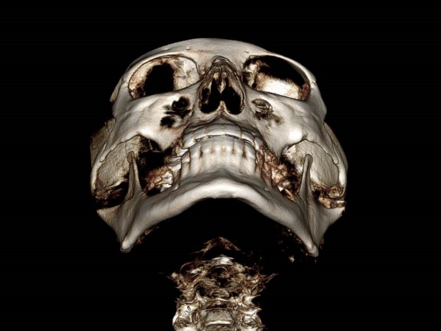 Understanding the Structure of the Cheekbone and Cheekbone Reduction Surgery image 5