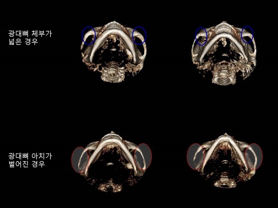 얼굴형에 따른 광대뼈 축소성형술 방법의 적절한 선택 관련 이미지 2