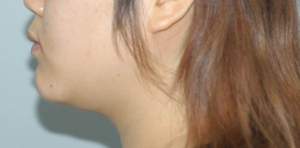 Double Chin Liposuction image 2