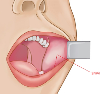 Jaw Angle Surgery: Is It a Clever Way to “Transform Completely”? image 1
