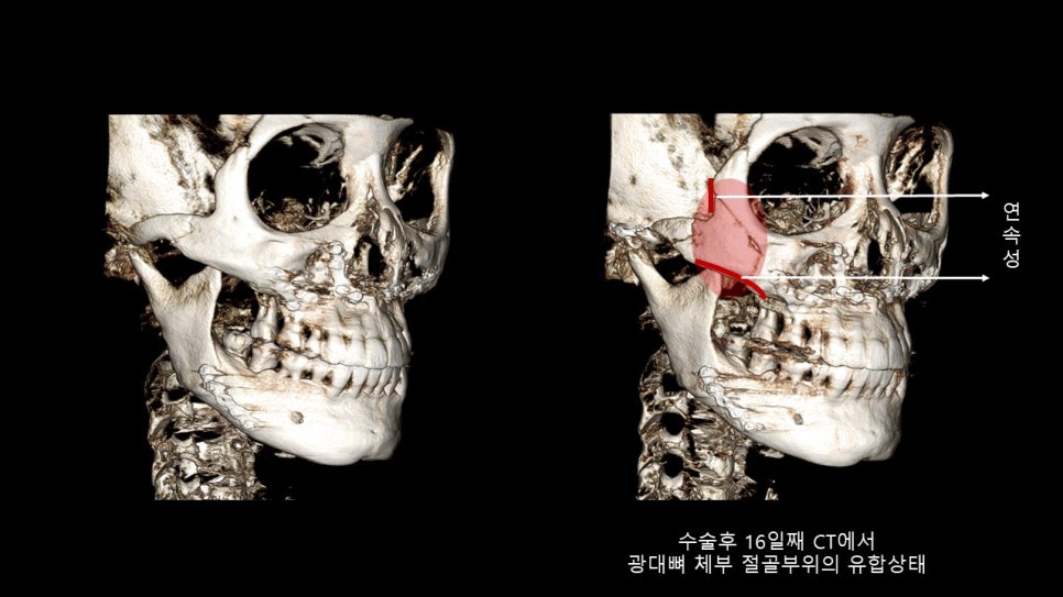 광대뼈축소성형술 증례 리뷰 -1 관련 이미지 7