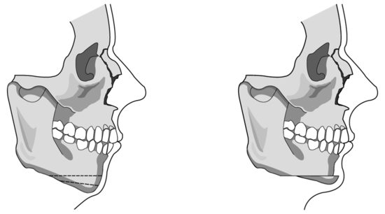 Profile Shaping - 1. Chin Surgery for a Recessed Chin image 2