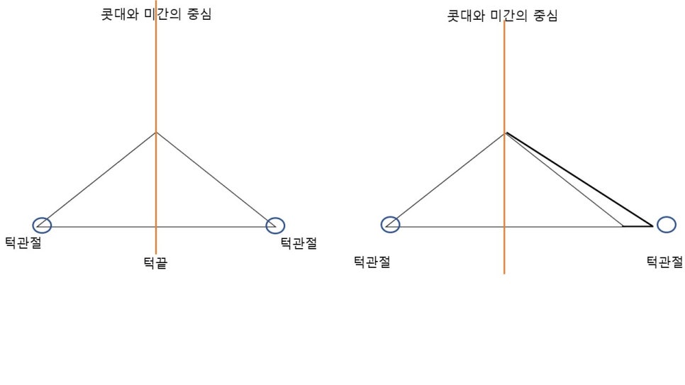 안면윤곽수술과 비대칭 교정의 효과 관련 이미지 5