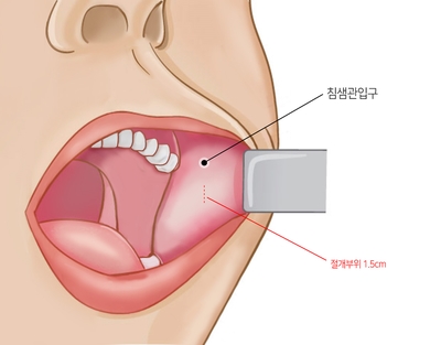 안면윤곽수술에 관한 연재 - 1. 심부볼지방제거 수술 관련 이미지 9