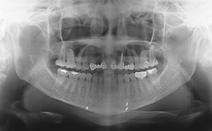 V-Line Square Jaw Revision Surgery image 4