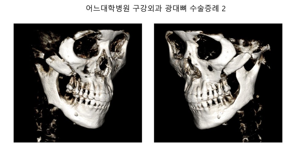 안면윤곽 수술전과 후의 증례 고찰 관련 이미지 18