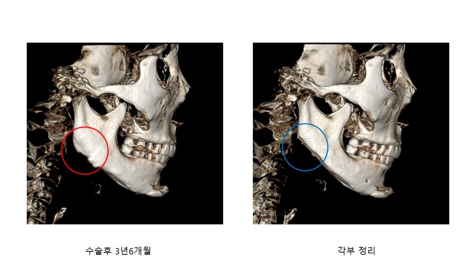 사각턱 수술후 시기에 따른 아랫턱뼈의 형태변화 관련 이미지 19
