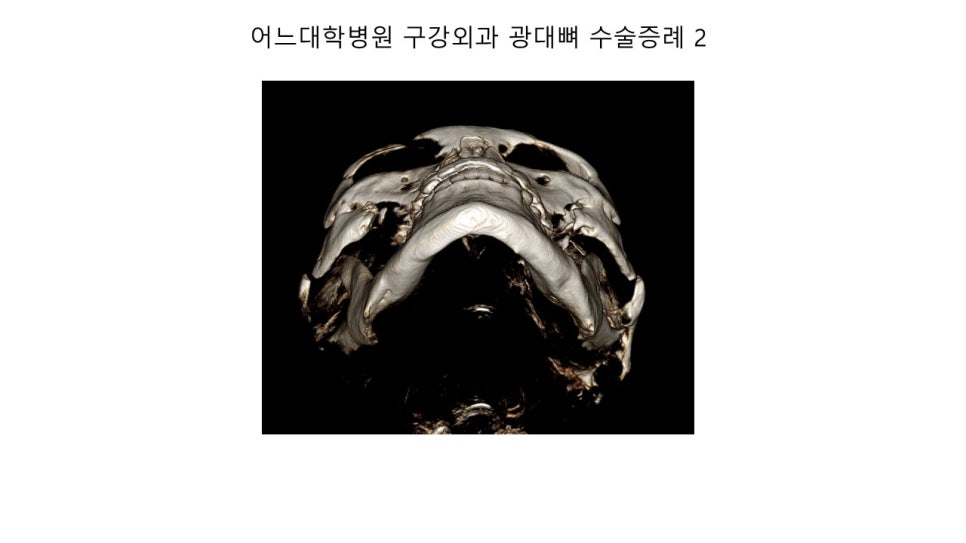 안면윤곽 수술전과 후의 증례 고찰 관련 이미지 17